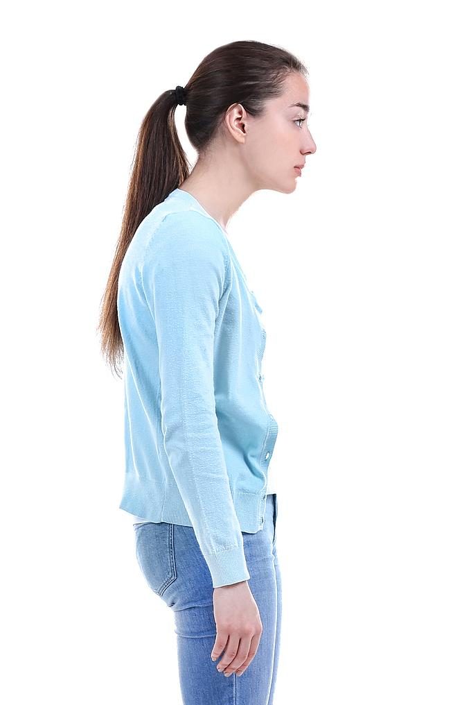 Woman demonstrating swayback posture with forward pelvis and rounded back