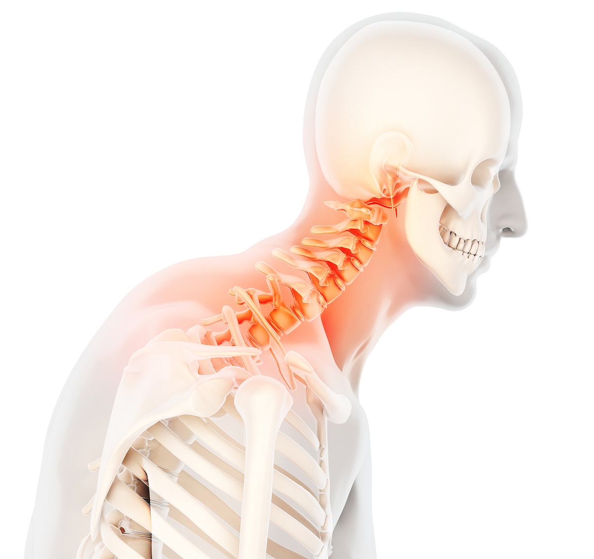 forward head posture example showing head drifting ahead of shoulders (Toronto chiropractor)