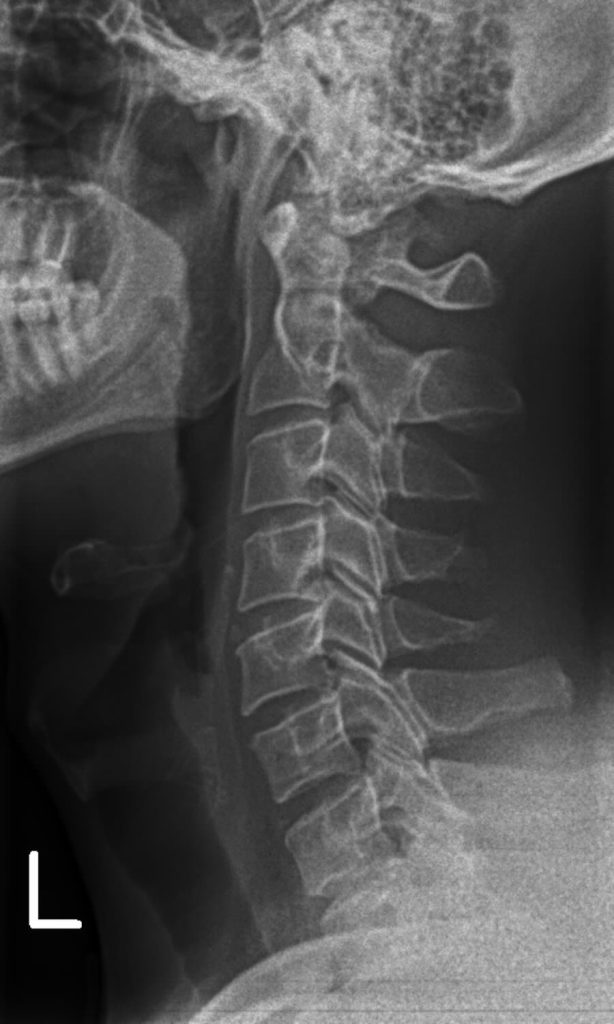 X-ray showing good cervical spine alignment