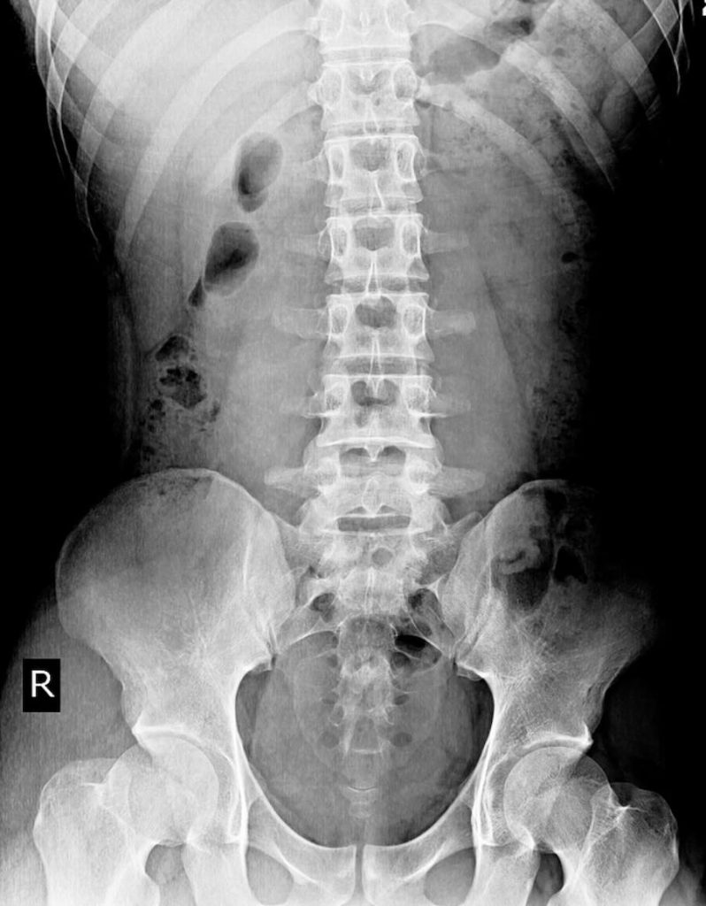 Digital spinal X-ray showing the alignment of the lower spine.