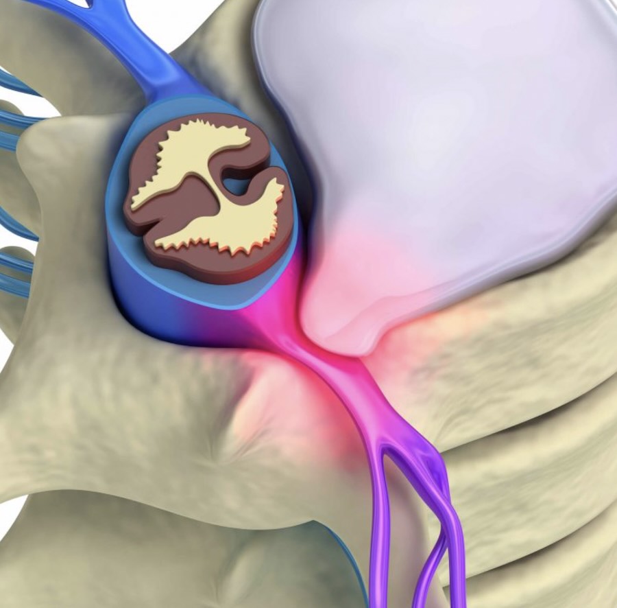 Illustration showing a lumbar disc bulge pressing on a nerve.